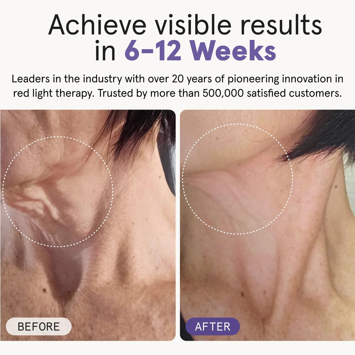 iRESTORE Illumina Chest & Neck Mask - HSA/FSA Eligible
